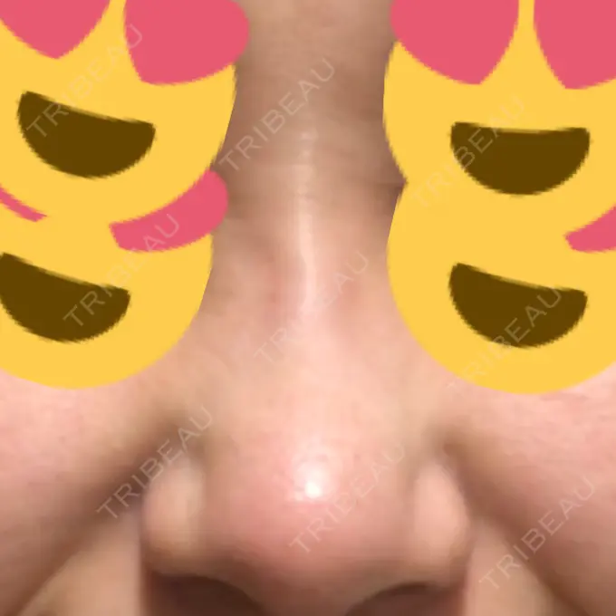 ヒアルロン酸注入（鼻） BIANCA銀座 DAY 2 メイン用