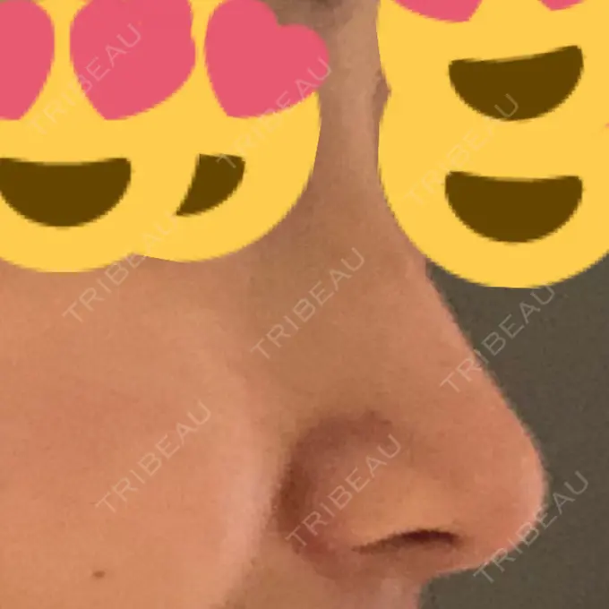 ヒアルロン酸注入（鼻） BIANCA銀座 DAY 2 メイン用