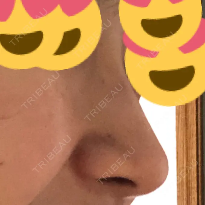 ヒアルロン酸注入（鼻） BIANCA銀座 AFTER メイン用