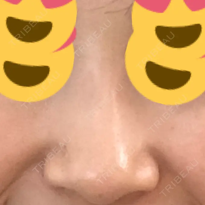 ヒアルロン酸注入（鼻） BIANCA銀座 DAY 4 メイン用