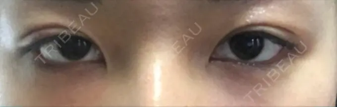 二重埋没 湘南美容クリニック 京都院 AFTER メイン用