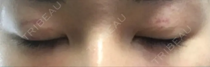 二重埋没 湘南美容クリニック 京都院 DAY 12 メイン用