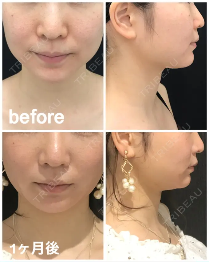 脂肪吸引（顔） / メーラーファット除去 湘南美容クリニック 秋葉原院 DAY 28 メイン用