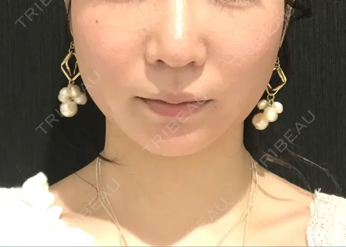 脂肪吸引（顔） / メーラーファット除去 湘南美容クリニック 秋葉原院 AFTER メイン用