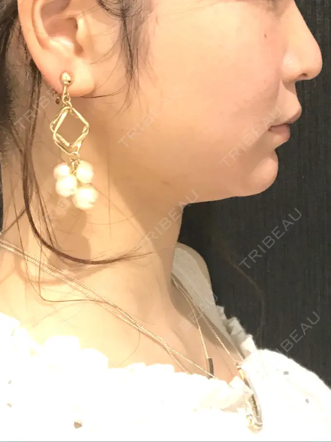 脂肪吸引（顔） / メーラーファット除去 湘南美容クリニック 秋葉原院 DAY 28 メイン用