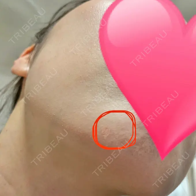 ほくろ・いぼ切除（肌） 医療法人美彩会 グランクリニック AFTER メイン用