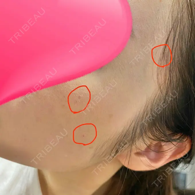 ほくろ・いぼ切除（肌） 医療法人美彩会 グランクリニック DAY 22 メイン用