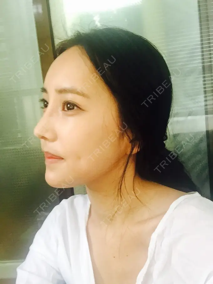 二重埋没 / 隆鼻術 / 鼻尖形成（切開） / 鼻中隔延長（切開） / 骨切り（あご） / 骨削り（エラ） / 骨削り（頬） / 軟骨移植 / ワシ鼻修正・ハンプ切除 DA美容外科 DAY 31 メイン用