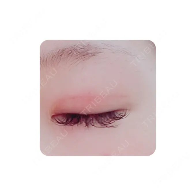 二重切開 カリスクリニック DAY 38 メイン用