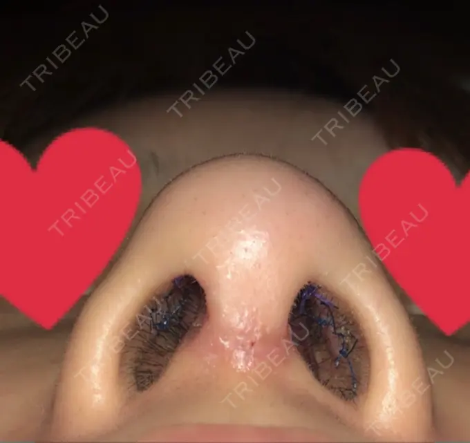 軟骨移植 / 骨切幅寄せ / ワシ鼻修正・ハンプ切除 / 鼻孔縁下降 加美（GAMI）整形外科 DAY 17 メイン用