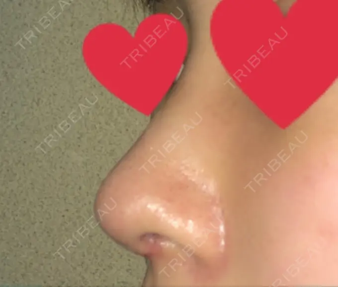 軟骨移植 / 骨切幅寄せ / ワシ鼻修正・ハンプ切除 / 鼻孔縁下降 加美（GAMI）整形外科 DAY 17 メイン用