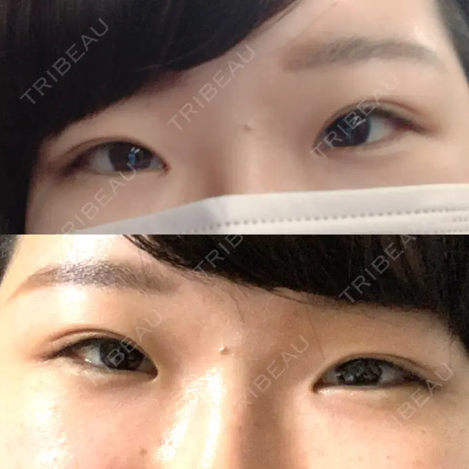 二重埋没 湘南美容クリニック 京都院 DAY 111 メイン用