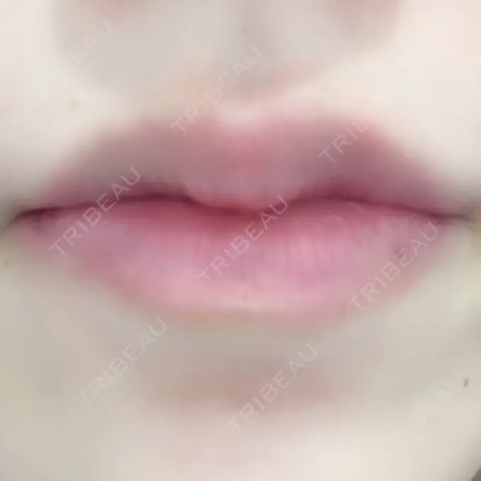 ヒアルロン酸注入（唇） / ボトックス（口角） ルラ美容クリニック 高田馬場院 DAY 0 メイン用