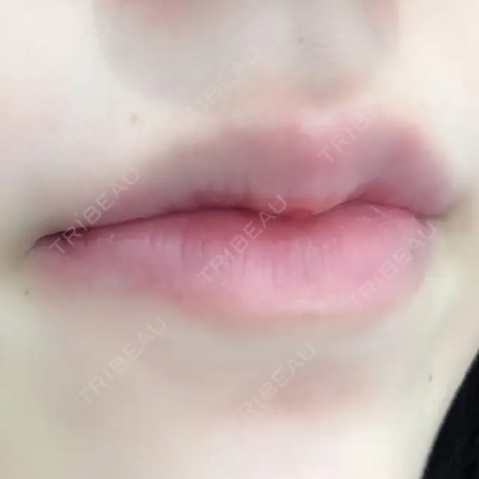 ヒアルロン酸注入（唇） / ボトックス（口角） ルラ美容クリニック 高田馬場院 DAY 0 メイン用