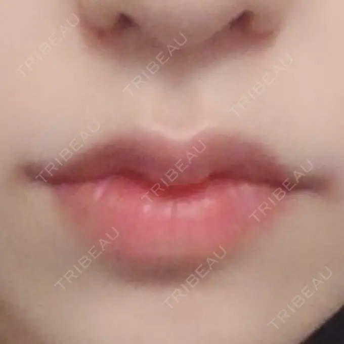 ヒアルロン酸注入（唇） / ボトックス（口角） ルラ美容クリニック 高田馬場院 DAY 1 メイン用