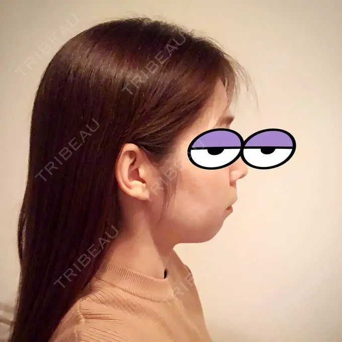 バッカルファット除去 / 脂肪吸引（顔） / ボトックス（エラ・小顔） THE PLAN（ザ・プラン）美容整形外科・皮膚科 DAY 10 メイン用