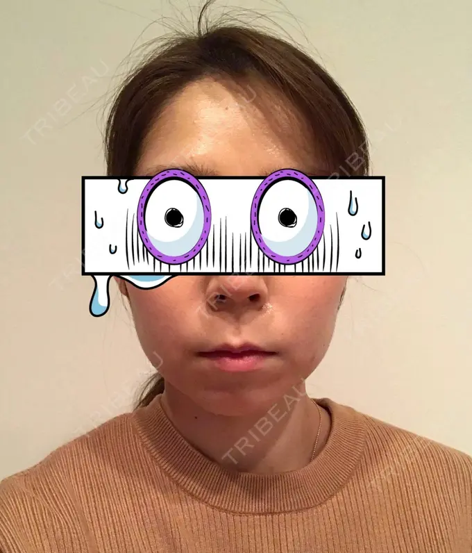 バッカルファット除去 / 脂肪吸引（顔） / ボトックス（エラ・小顔） THE PLAN（ザ・プラン）美容整形外科・皮膚科 DAY 32 メイン用