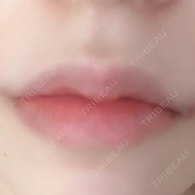 ヒアルロン酸注入（唇） / ボトックス（口角） ルラ美容クリニック 高田馬場院 DAY 2 メイン用