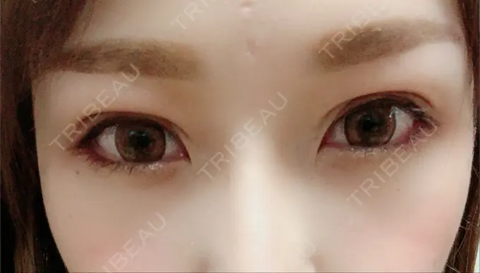 二重埋没 湘南美容クリニック 福島院 DAY 38 メイン用