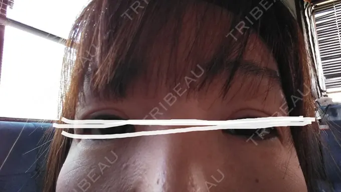 ボトックス（あご） TCB東京中央美容外科 宇都宮院 DAY 8 メイン用