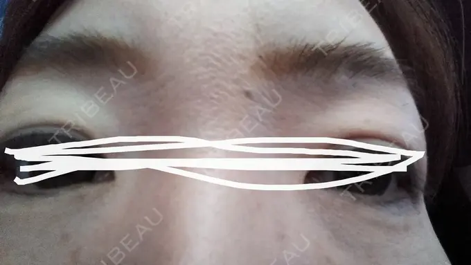 ボトックス（あご） TCB東京中央美容外科 宇都宮院 DAY 10 メイン用