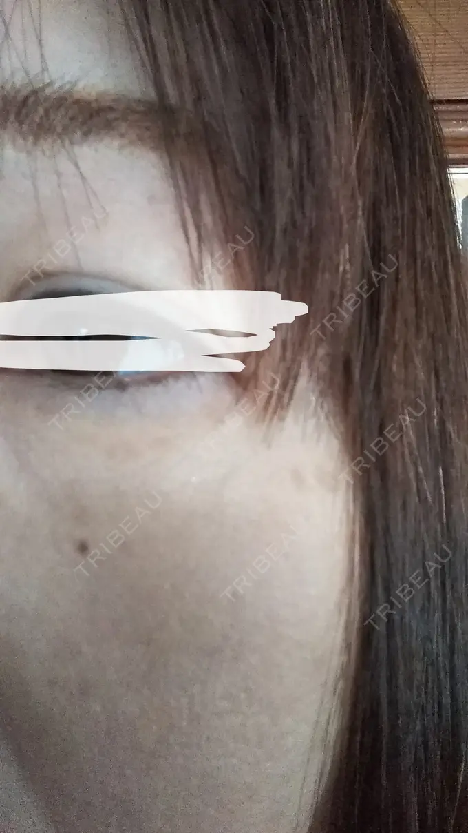 ボトックス（あご） TCB東京中央美容外科 宇都宮院 DAY 10 メイン用