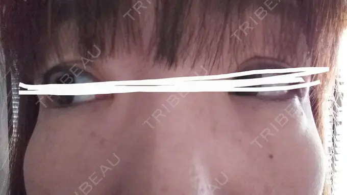 ボトックス（あご） TCB東京中央美容外科 宇都宮院 DAY 11 メイン用