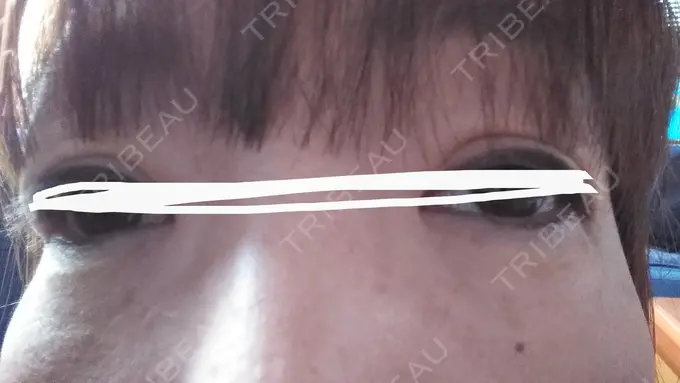 ボトックス（あご） TCB東京中央美容外科 宇都宮院 DAY 20 メイン用