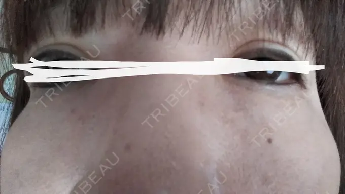 ボトックス（あご） TCB東京中央美容外科 宇都宮院 DAY 14 メイン用