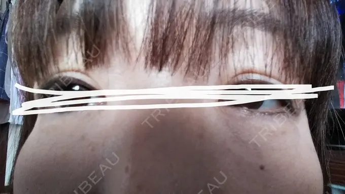 ボトックス（あご） TCB東京中央美容外科 宇都宮院 DAY 16 メイン用