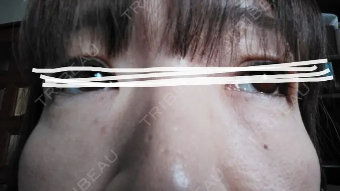 ボトックス（あご） TCB東京中央美容外科 宇都宮院 DAY 20 メイン用