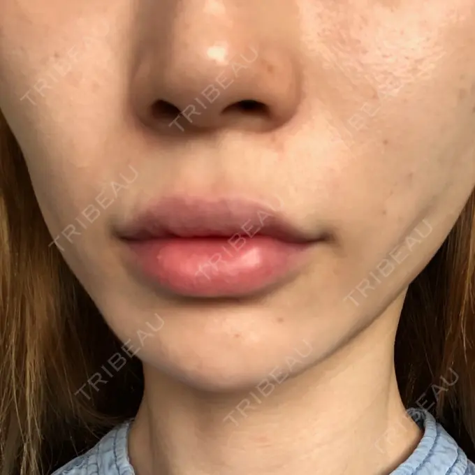 糸リフト / 肌ヒアルロン酸注入（たるみ・シワ改善） / ボトックス（エラ・小顔） 大阪TAクリニック AFTER メイン用