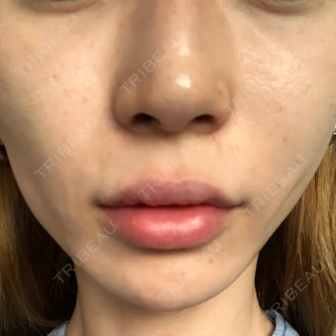 糸リフト / 肌ヒアルロン酸注入（たるみ・シワ改善） / ボトックス（エラ・小顔） 大阪TAクリニック DAY 32 メイン用