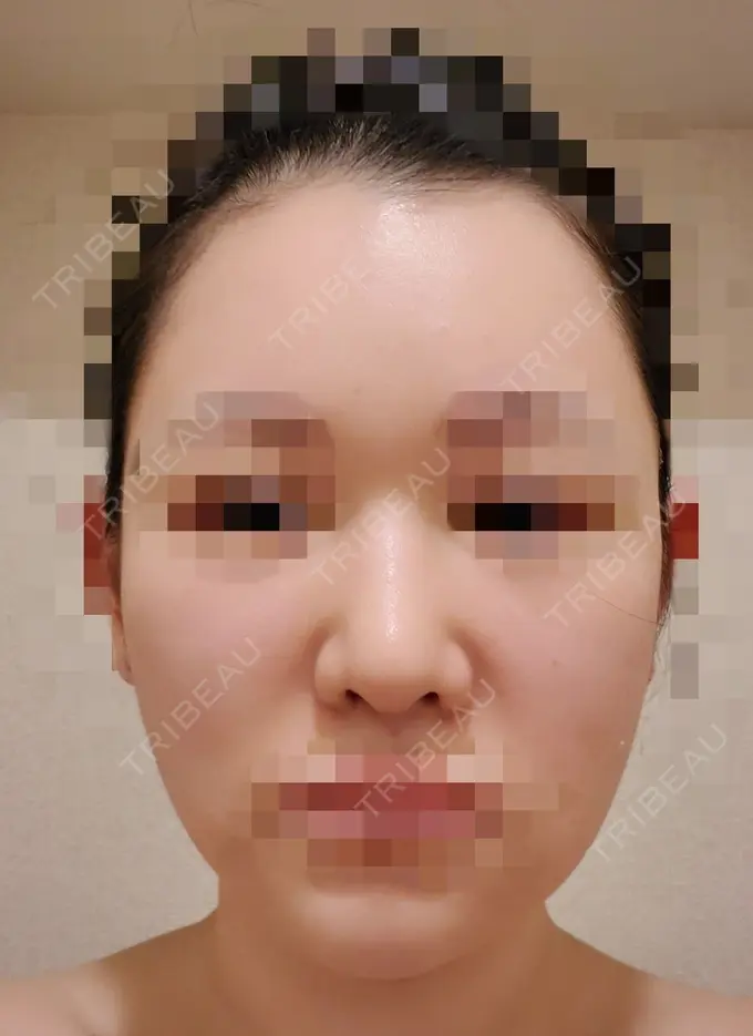 小鼻縮小（切開） / 骨切り（あご） / 骨削り（エラ） / 骨削り（頬） / バッカルファット除去 / 脂肪吸引（顔） / 軟骨移植 RG整形外科（旧リオン整形外科） DAY 21 メイン用