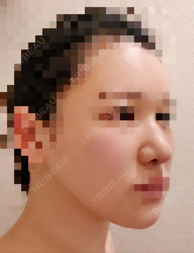 小鼻縮小（切開） / 骨切り（あご） / 骨削り（エラ） / 骨削り（頬） / バッカルファット除去 / 脂肪吸引（顔） / 軟骨移植 RG整形外科（旧リオン整形外科） DAY 21 メイン用