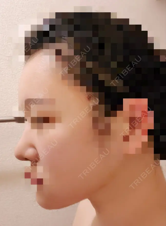 小鼻縮小（切開） / 骨切り（あご） / 骨削り（エラ） / 骨削り（頬） / バッカルファット除去 / 脂肪吸引（顔） / 軟骨移植 RG整形外科（旧リオン整形外科） DAY 21 メイン用