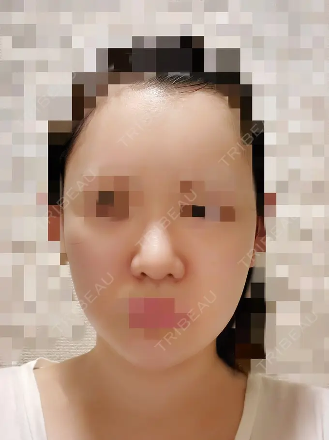 小鼻縮小（切開） / 骨切り（あご） / 骨削り（エラ） / 骨削り（頬） / バッカルファット除去 / 脂肪吸引（顔） / 軟骨移植 RG整形外科（旧リオン整形外科） DAY 77 メイン用