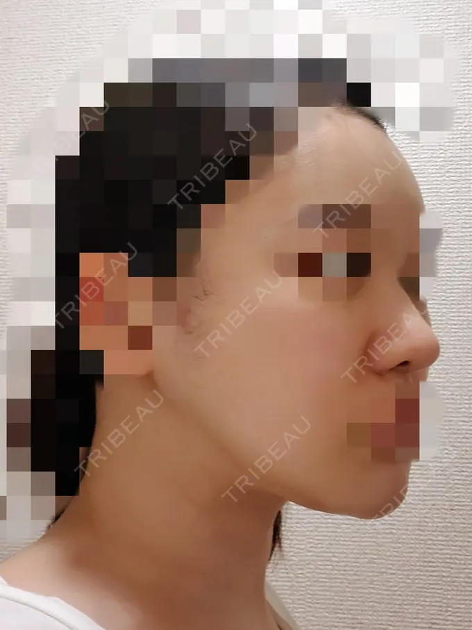 小鼻縮小（切開） / 骨切り（あご） / 骨削り（エラ） / 骨削り（頬） / バッカルファット除去 / 脂肪吸引（顔） / 軟骨移植 RG整形外科（旧リオン整形外科） DAY 77 メイン用