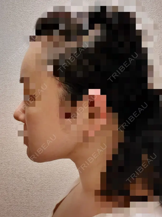 小鼻縮小（切開） / 骨切り（あご） / 骨削り（エラ） / 骨削り（頬） / バッカルファット除去 / 脂肪吸引（顔） / 軟骨移植 RG整形外科（旧リオン整形外科） DAY 77 メイン用