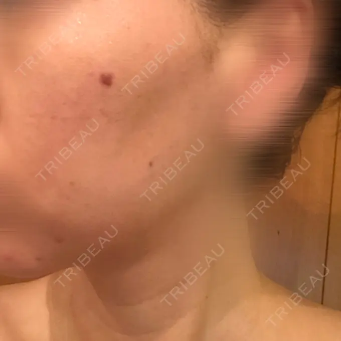 ピーリング（ニキビ・毛穴） / ピコレーザートーニング（美白・肝斑） / YAGレーザー 赤坂ビューティークリニック DAY 2 メイン用