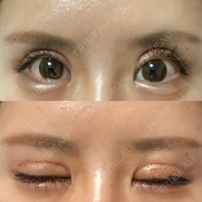 二重切開 / 目元修正 心斎橋コムロ美容外科クリニック DAY 80 メイン用