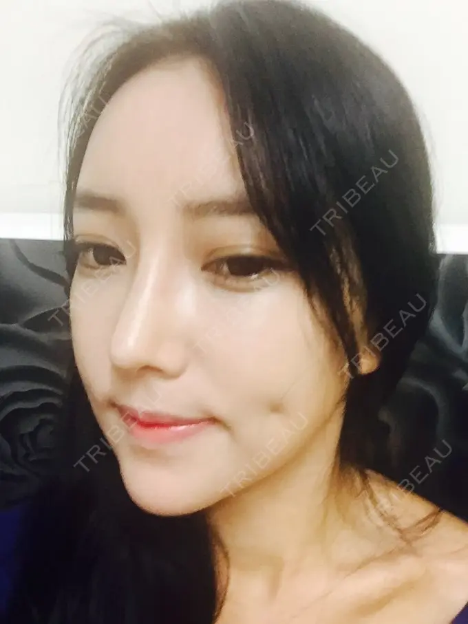 二重埋没 / 隆鼻術 / 鼻尖形成（切開） / 鼻中隔延長（切開） / 骨切り（あご） / 骨削り（エラ） / 骨削り（頬） / 軟骨移植 / ワシ鼻修正・ハンプ切除 DA美容外科 DAY 63 メイン用