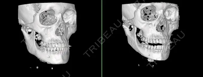 小鼻縮小（切開） / 骨切り（あご） / 骨削り（エラ） / 骨削り（頬） / バッカルファット除去 / 脂肪吸引（顔） / 軟骨移植 RG整形外科（旧リオン整形外科） DAY 80 メイン用