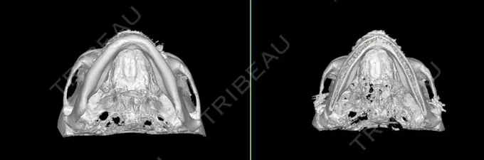 小鼻縮小（切開） / 骨切り（あご） / 骨削り（エラ） / 骨削り（頬） / バッカルファット除去 / 脂肪吸引（顔） / 軟骨移植 RG整形外科（旧リオン整形外科） DAY 80 メイン用