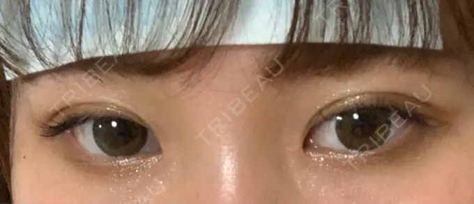 二重埋没 湘南美容クリニック 赤坂見附院 DAY 1 メイン用