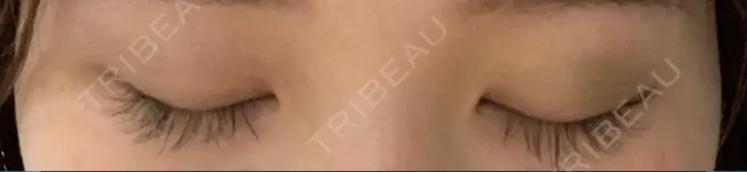 二重埋没 湘南美容クリニック 赤坂見附院 DAY 1 メイン用