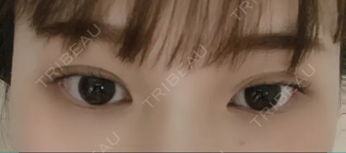 二重埋没 湘南美容クリニック 赤坂見附院 DAY 64 メイン用