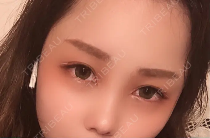 二重埋没 / 目頭切開 ドクター松井クリニック 新宿 AFTER メイン用