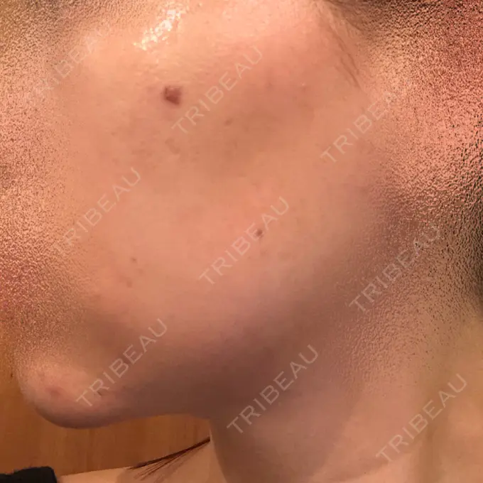 ピーリング（ニキビ・毛穴） / ピコレーザートーニング（美白・肝斑） / YAGレーザー 赤坂ビューティークリニック DAY 5 メイン用