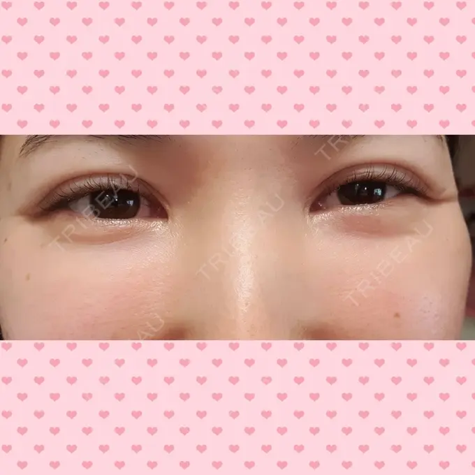 シワ取りボトックス CLASSY 仙台美容外科・美容皮膚科 DAY 39 メイン用